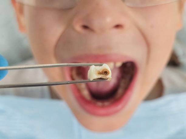 Best Emergency Dental Extractions in Kutztown University, PA